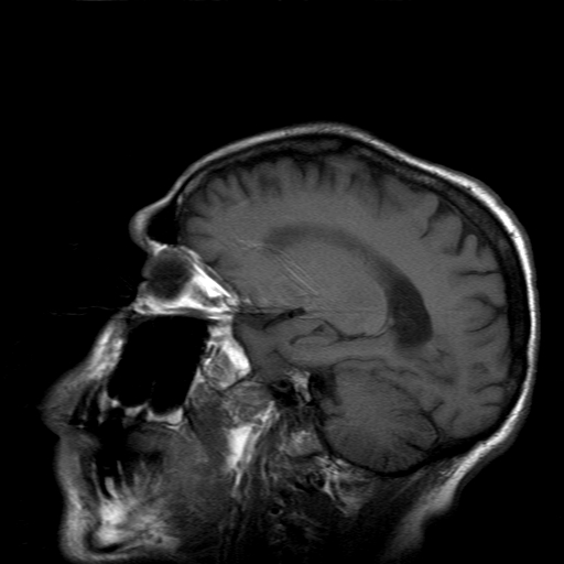 File:Acute necrotizing toxoplasma encephalitis (Radiopaedia 10683-11149 Sagittal T1 fat sat 13).jpg