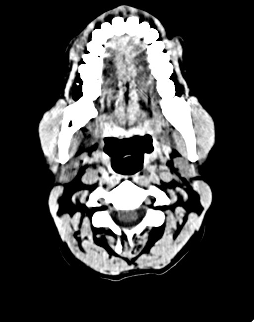 Acute on chronic subdural hematoma (Radiopaedia 74814-85823 Axial non-contrast 14).jpg