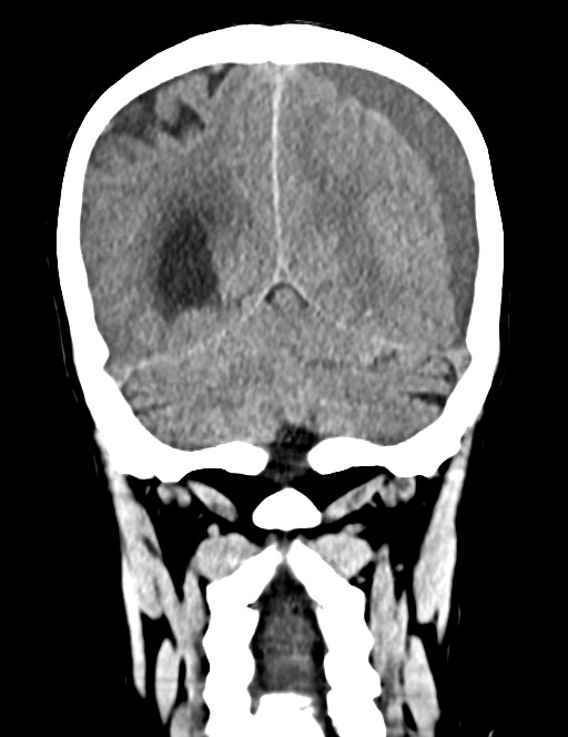 Acute on chronic subdural hematoma (Radiopaedia 74814-85823 Coronal non-contrast 49).jpg