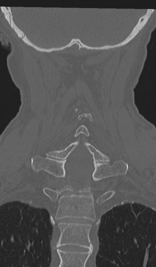 Acute on chronic subdural hematoma and thoracic vertebral injury in a multitrauma patient (Radiopaedia 31698-32619 Coronal bone window 46).jpg