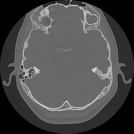 Acute otomastoiditis and Bezold abscess (Radiopaedia 88184-104786 Axial bone window 46).jpg