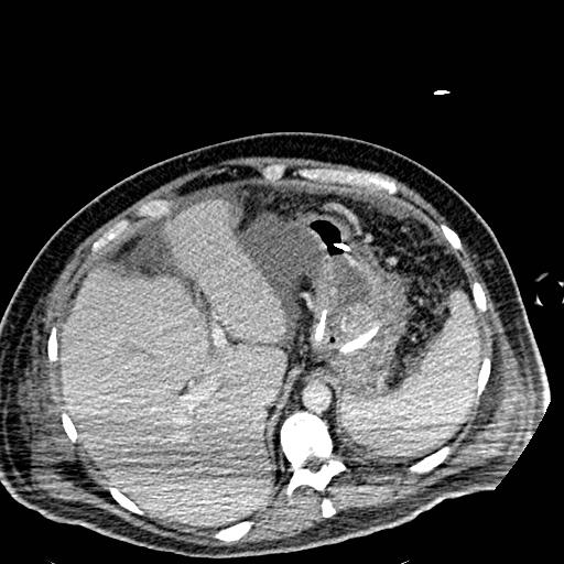 File:Acute pancreatic necrosis (Radiopaedia 13560-18501 Axial C+ portal venous phase 26).jpg