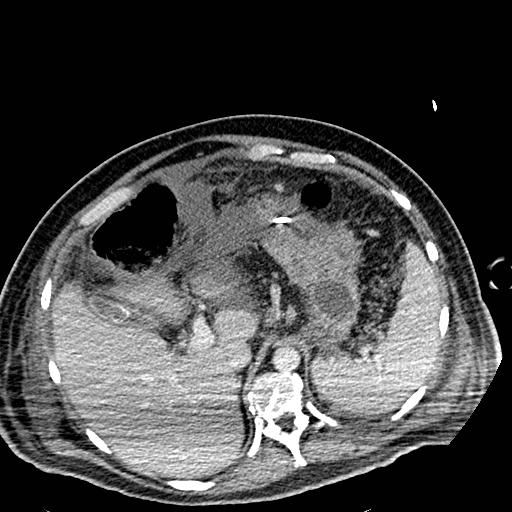 File:Acute pancreatic necrosis (Radiopaedia 13560-18501 Axial C+ portal venous phase 30).jpg