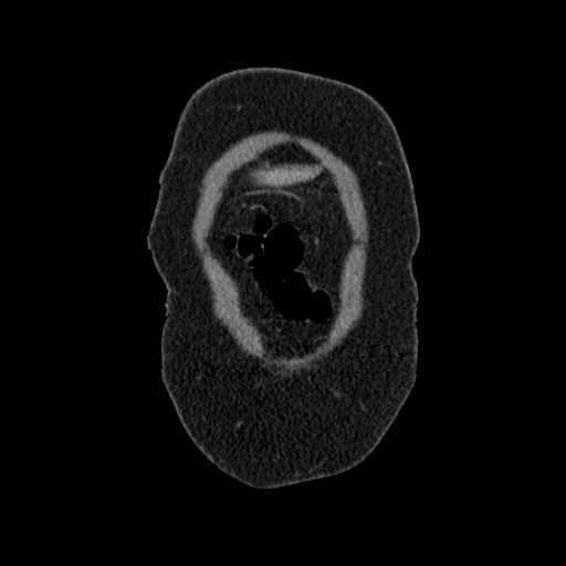 File:Acute pancreatitis (Radiopaedia 20829-20744 Coronal C+ portal venous phase 4).jpg