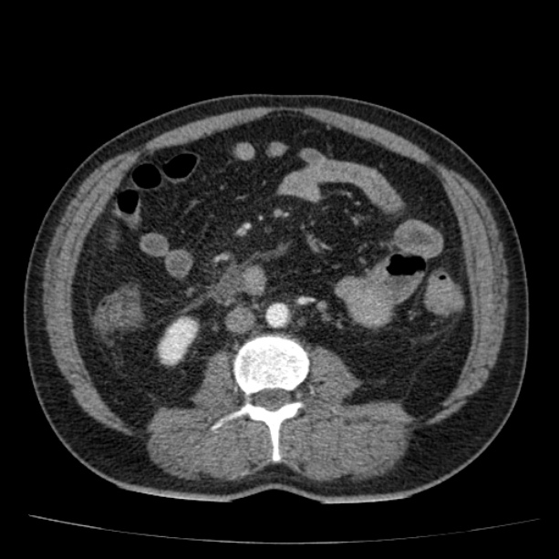 Acute pancreatitis (Radiopaedia 26663-26813 Axial C+ arterial phase 56).jpg
