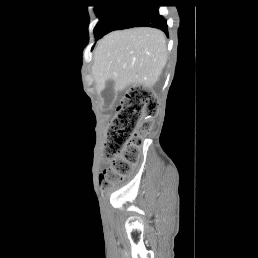 File:Acute pancreatitis (Radiopaedia 50213-55558 Sagittal C+ portal venous phase 2).jpg