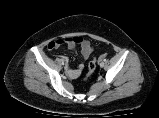 Acute pancreatitis (Radiopaedia 69236-79012 Axial C+ portal venous phase 76).jpg