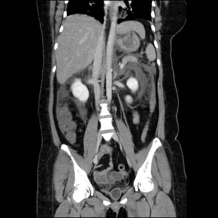 Acute pancreatitis (Radiopaedia 69236-79012 Coronal C+ portal venous phase 37).jpg