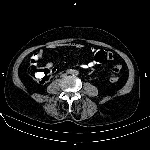 File:Acute pancreatitis (Radiopaedia 85146-100701 Axial non-contrast 78).jpg