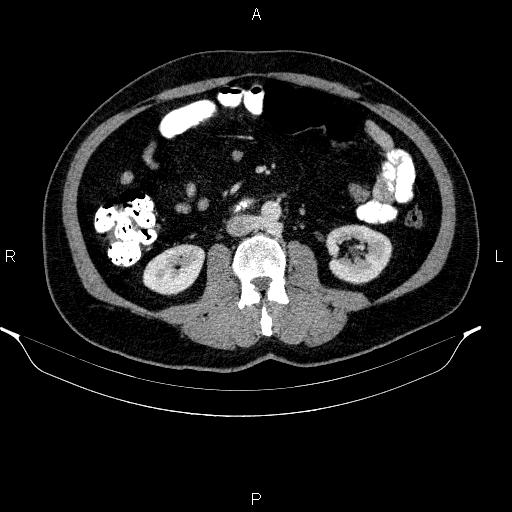 Acute pancreatitis (Radiopaedia 85390-101010 Axial C+ portal venous phase 55).jpg