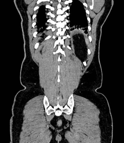 Acute pancreatitis (Radiopaedia 87428-103757 Coronal C+ portal venous phase 80).jpg