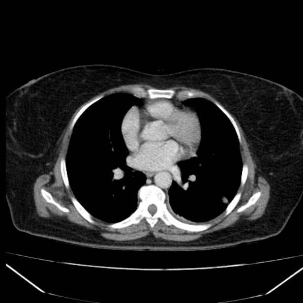 Acute pancreatitis - Balthazar C (Radiopaedia 26569-26714 Axial C+ portal venous phase 8).jpg