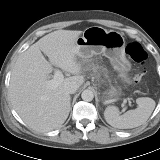 File:Acute pancreatitis and walled-off necrosis (Radiopaedia 29888-30403 Axial C+ delayed 21).jpg