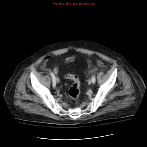 File:Acute pancreatitis with incidental pancreatic lipoma (Radiopaedia 10190-10730 Axial C+ portal venous phase 65).jpg
