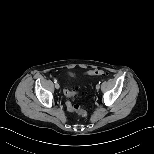 Acute renal infarction (Radiopaedia 59375-66736 Axial C+ portal venous phase 98).jpg