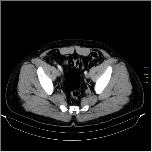 Acute right sided diverticulitis (Radiopaedia 65249-74268 Axial C+ portal venous phase 68).JPG