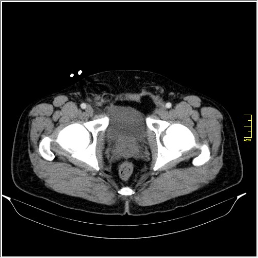 Acute right sided diverticulitis (Radiopaedia 65249-74268 Axial C+ portal venous phase 77).JPG