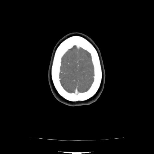 Acute subarachnoid hemorrhage and accessory anterior cerebral artery (Radiopaedia 69231-79009 Axial C+ arterial phase 120).jpg