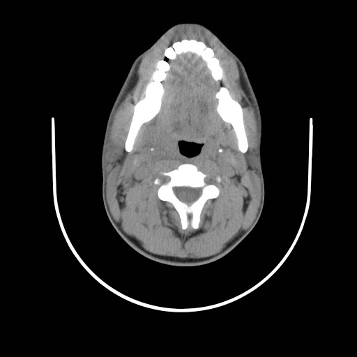 File:Acute submandibular sialadenitis secondary to ductal stone (Radiopaedia 27999-28267 Axial non-contrast 9).jpg
