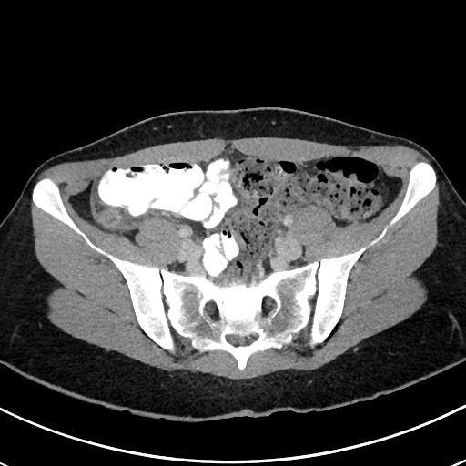 File:Acute uncomplicated appendicitis (Radiopaedia 61374-69304 Axial C+ portal venous phase 91).jpg