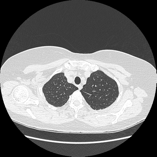Adenocarcinoma in situ of lung (Radiopaedia 38685-40829 B 37).png