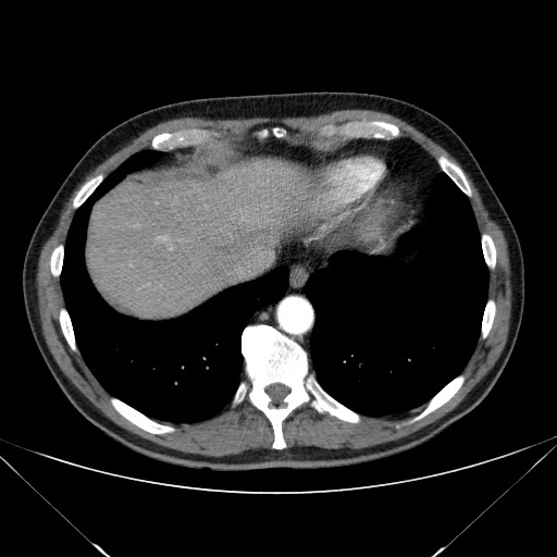 Adenocarcinoma of the lung (Radiopaedia 59871-67325 Axial C+ arterial phase 77).jpg