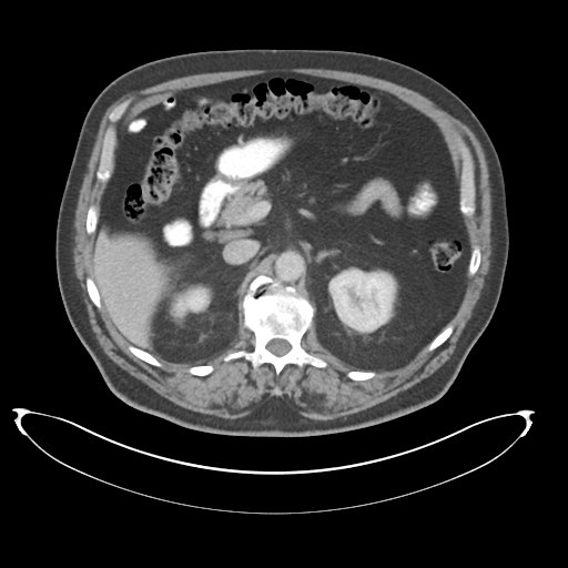 File:Adenocarcioma of rectum- T1 lesion (Radiopaedia 36921-38547 Axial C+ portal venous phase 30).png
