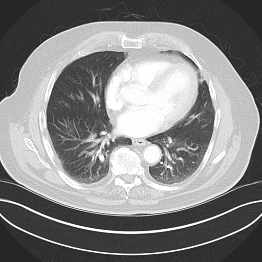Adenocarcioma of rectum- T1 lesion (Radiopaedia 36921-38547 Axial lung window 35).png