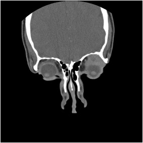 File:Adenoid cystic carcinoma of the lacrimal gland (Radiopaedia 10999-11416 Coronal non-contrast 1).jpg