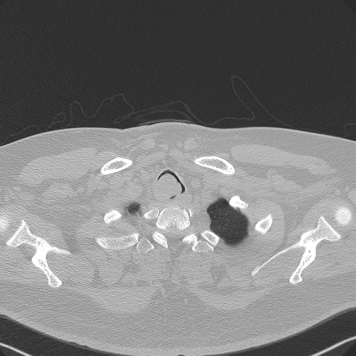 Adenoid cystic carcinoma of the trachea (Radiopaedia 49042-54137 Axial lung window 24).jpg