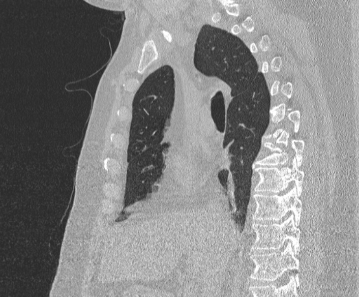 File:Adenoid cystic carcinoma of the trachea (Radiopaedia 49042-54137 Sagittal lung window 207).jpg