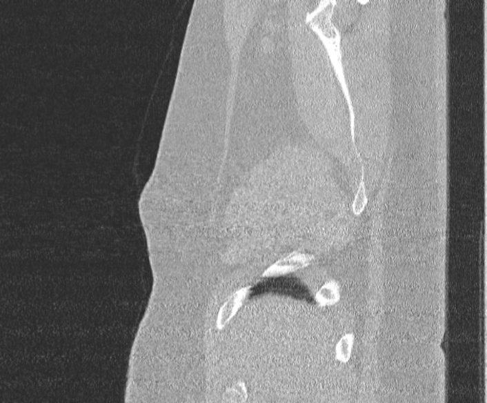 Adenoid cystic carcinoma of the trachea (Radiopaedia 49042-54137 Sagittal lung window 28).jpg