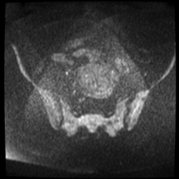 File:Adenomyosis-scar endometriosis (Radiopaedia 65863-75022 Axial DWI 1).jpg
