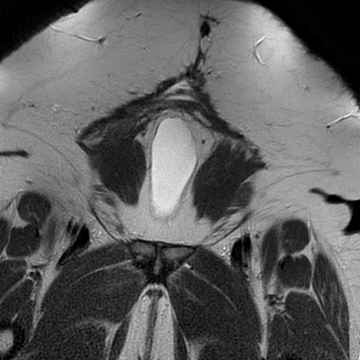 File:Adenomyosis within a didelphys uterus (Radiopaedia 70175-80215 Coronal T2 1).jpg