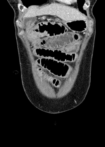 Adhesional small bowel obstruction (Radiopaedia 48397-53305 Coronal C+ portal venous phase 57).jpg