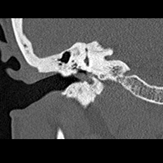 File:Adhesive chronic otitis media (Radiopaedia 14270-14148 Coronal bone window - right 13).jpg
