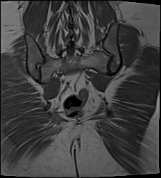 File:Adnexal multilocular cyst (O-RADS US 3- O-RADS MRI 3) (Radiopaedia 87426-103754 Coronal 29).jpg