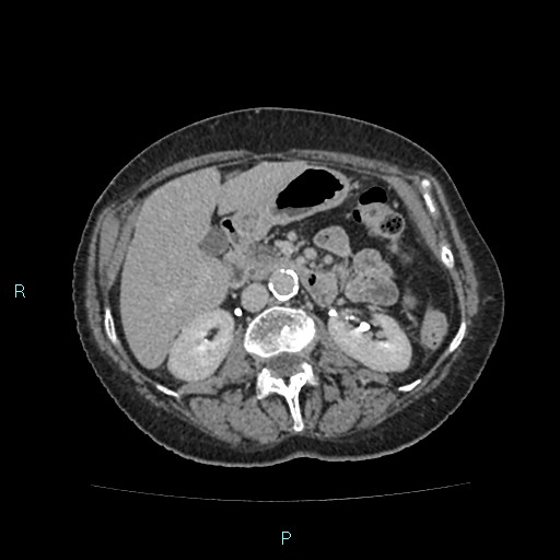 File:Adrenal collision tumor (ACT) (Radiopaedia 48462-53379 Axial C+ delayed 27).jpg