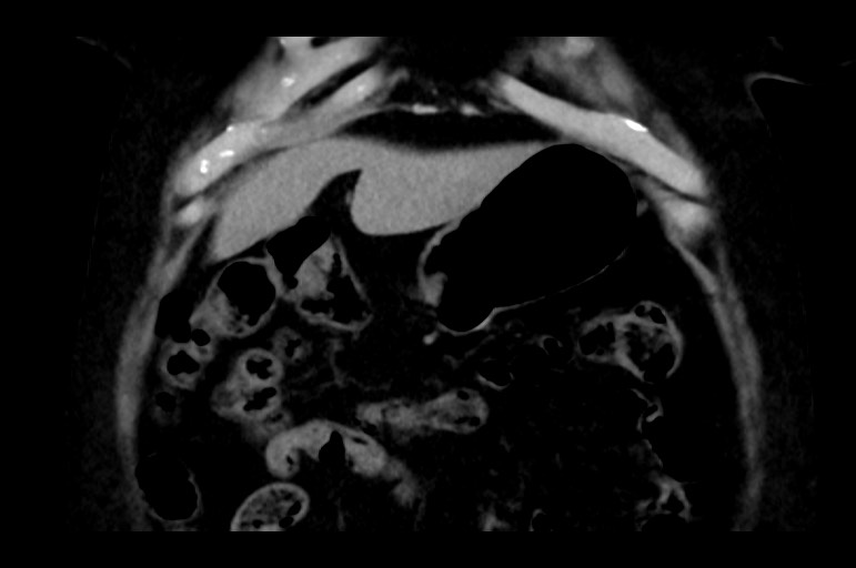 Adrenal cortical carcinoma (Radiopaedia 64017-72769 Coronal non-contrast 12).jpg