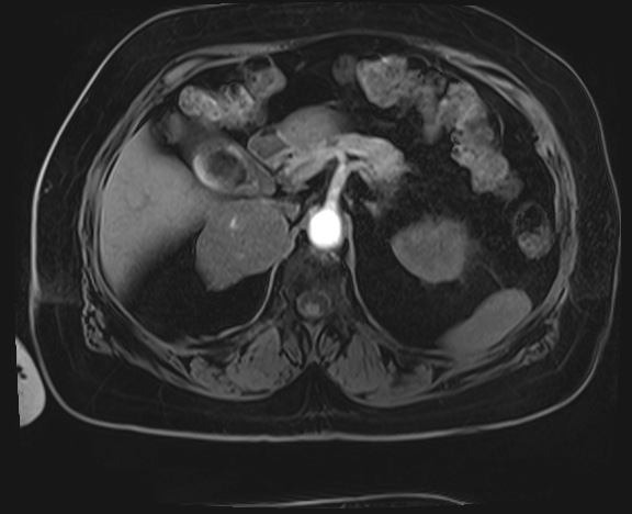 Adrenal cortical carcinoma (Radiopaedia 64017-72770 Axial T1 C+ fat sat 11).jpg