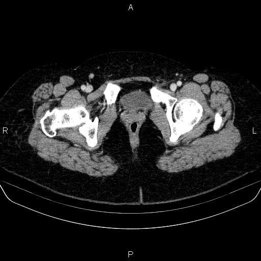 File:Adrenal cortical carcinoma (Radiopaedia 84882-100379 Axial C+ portal venous phase 96).jpg