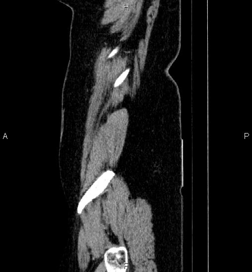 Adrenal cortical carcinoma (Radiopaedia 84882-100379 Sagittal C+ portal venous phase 84).jpg