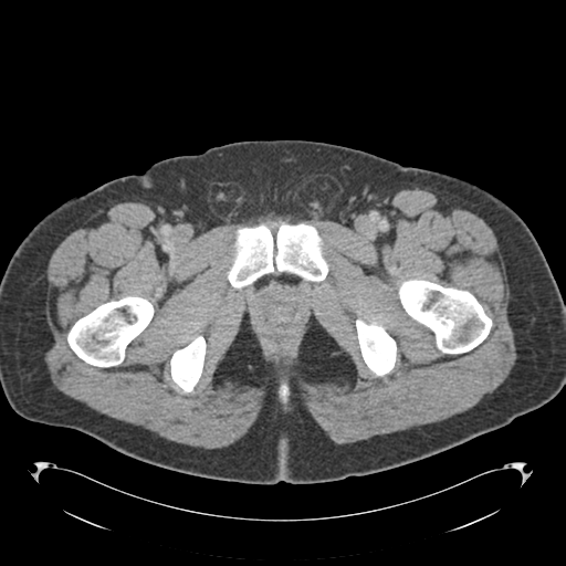 File:Adrenal cyst (Radiopaedia 45625-49776 Axial C+ portal venous phase 100).png