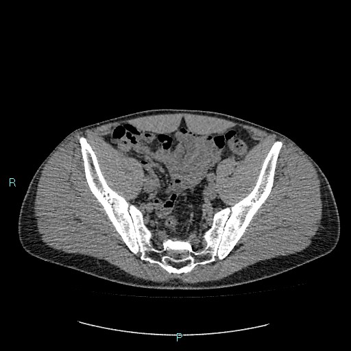 Adrenal cystic lymphangioma (Radiopaedia 83161-97534 Axial non-contrast 79).jpg