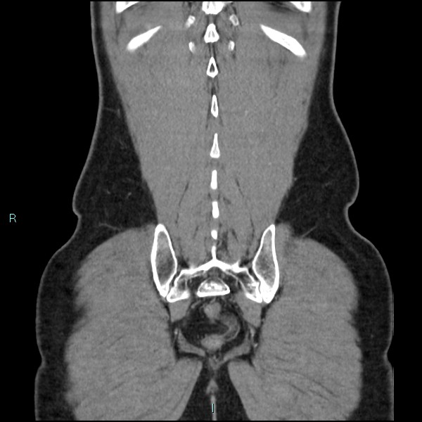 Adrenal cystic lymphangioma (Radiopaedia 83161-97534 Coronal C+ portal venous phase 68).jpg