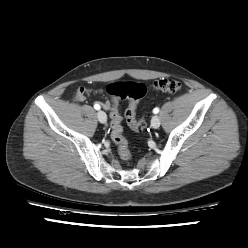 Adrenal gland trauma (Radiopaedia 81351-95078 Axial Dual bolus trauma C+ 106).jpg