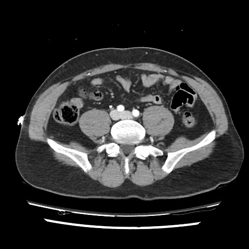 File:Adrenal gland trauma (Radiopaedia 81351-95078 Axial Dual bolus trauma C+ 93).jpg