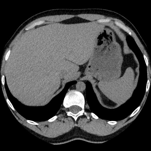 Adrenal gland trauma (Radiopaedia 81351-95079 Axial non-contrast 20).jpg