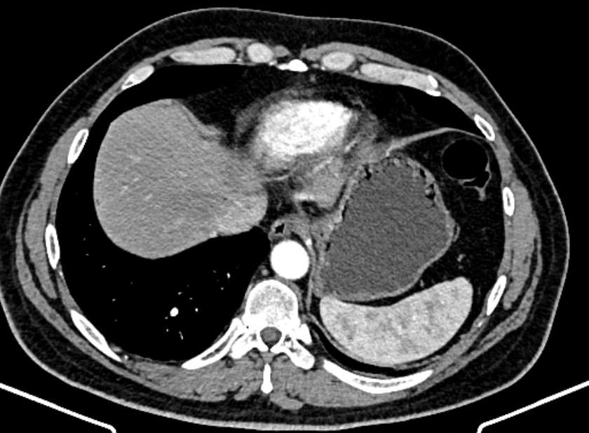 Adrenal metastases (Radiopaedia 73082-83791 Axial C+ arterial phase 17).jpg