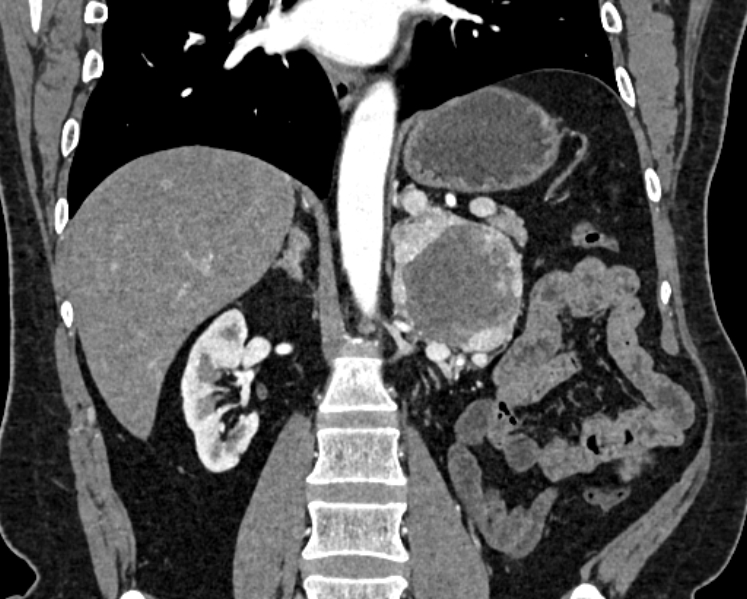 File:Adrenal metastases (Radiopaedia 73082-83791 Coronal C+ arterial phase 36).jpg